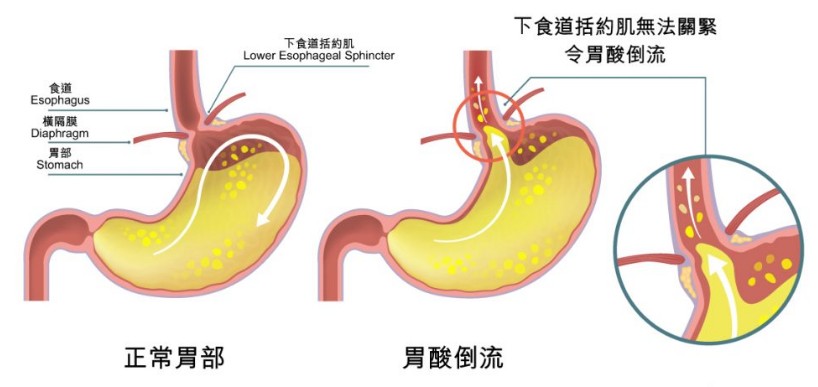 哪些症狀屬於樂軒昂常見的胃部副作用? 哪些症狀屬於樂軒昂常見的胃部副作用?